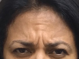 Glabellar Lines Solution Before Glabellar Lines Solution Before