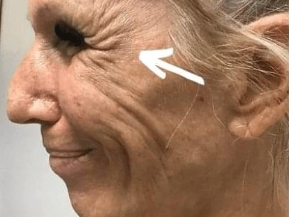 Crow's Feet Before Crow's Feet Before