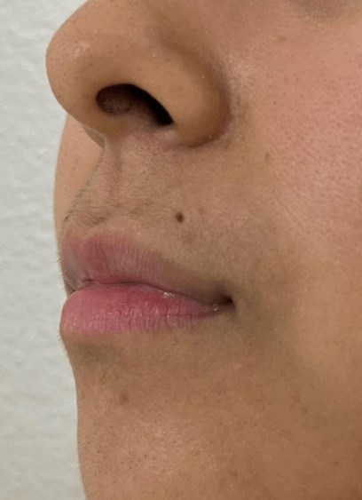 B&A Lip Filler (Side View) Before B&A Lip Filler (Side View) Before