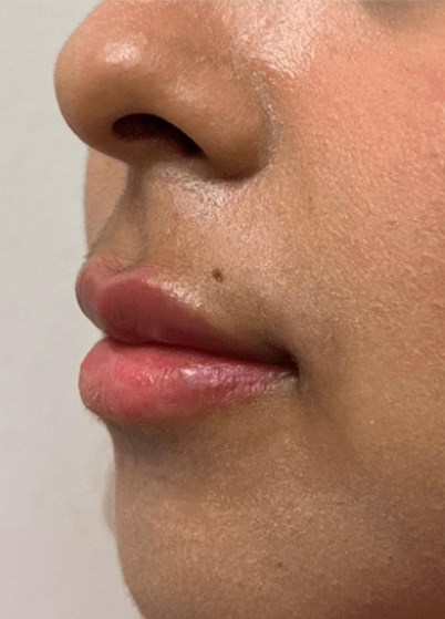 B&A Lip Filler (Side View) After B&A Lip Filler (Side View) After