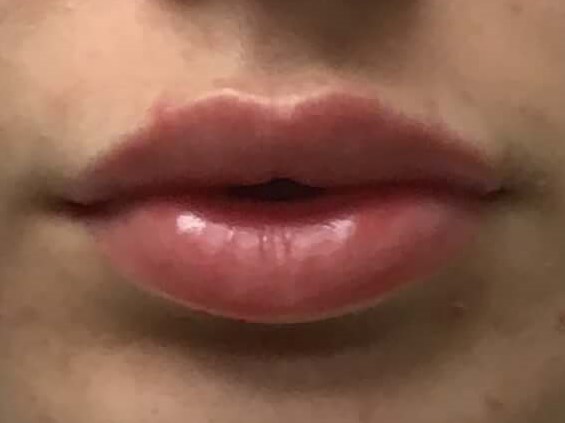 Before and After Lip Filler After Before and After Lip Filler After