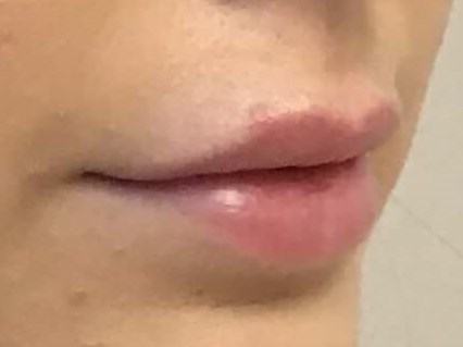 Side View Before Side View Before