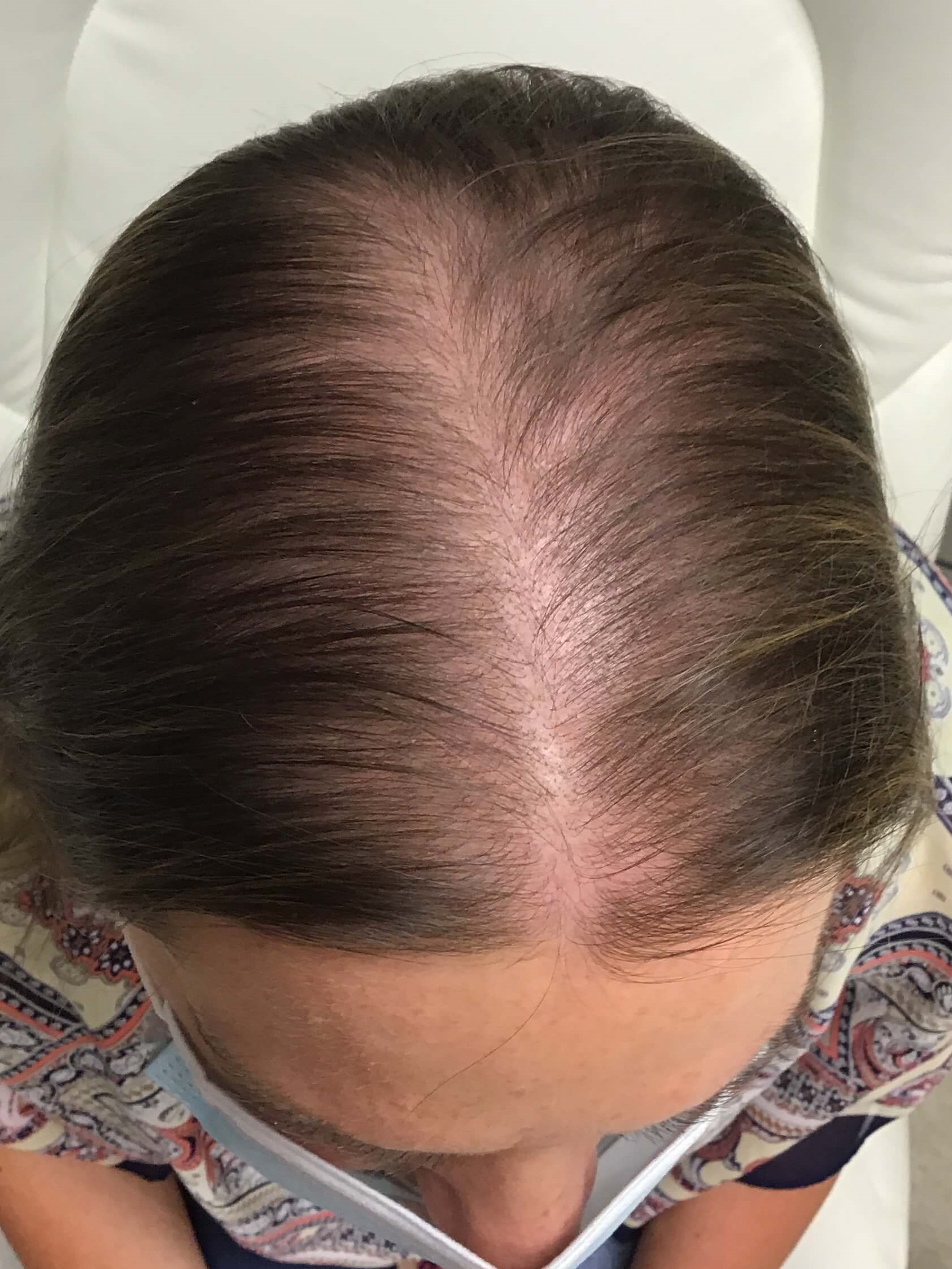 Hair Regrowth After Hair Regrowth After