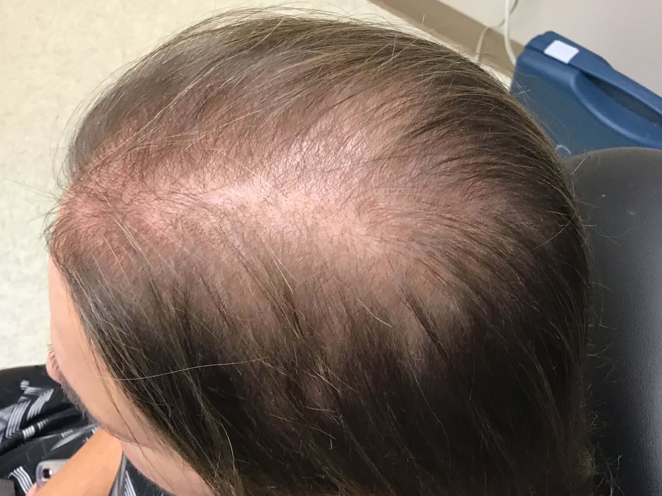 Hair Regrowth Before Hair Regrowth Before