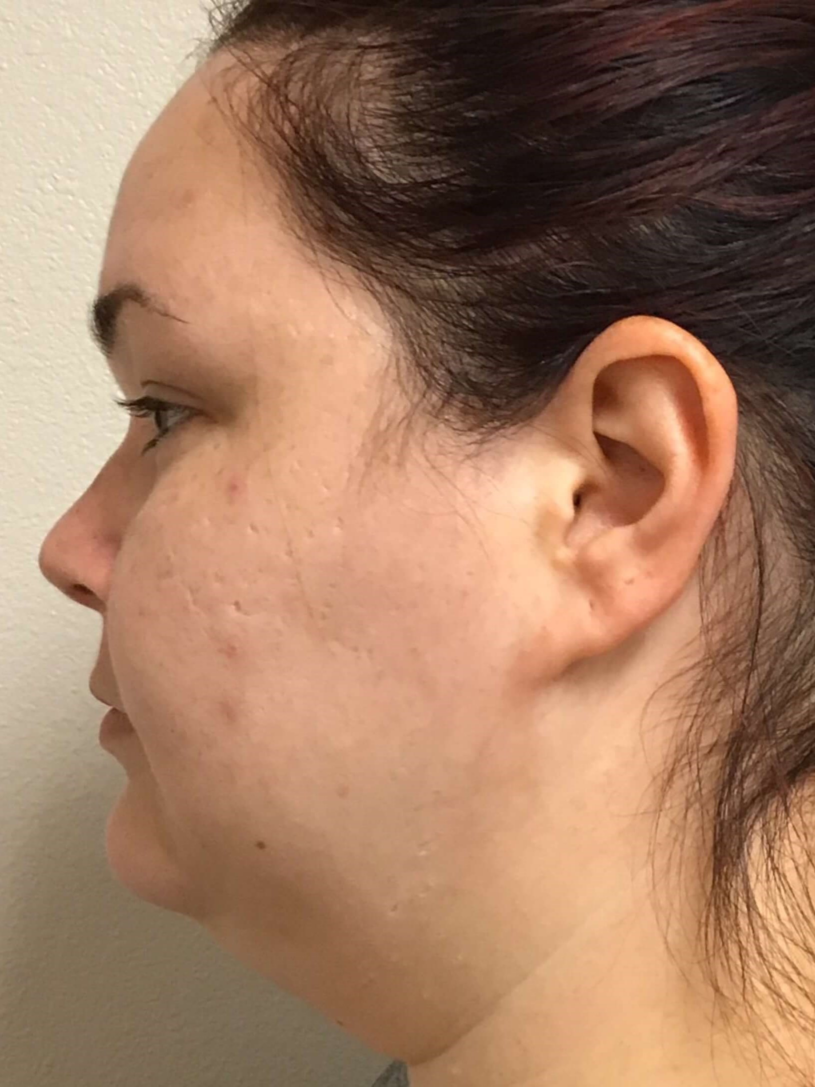 Before and After Liposuction Before Before and After Liposuction Before