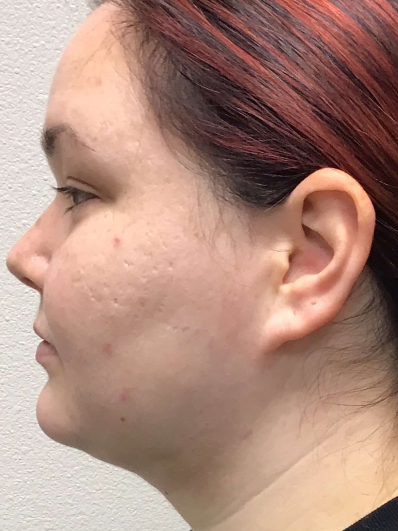 Before and After Liposuction After Before and After Liposuction After