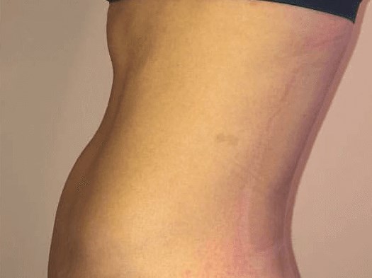 Before and After TruSculpt 3D After Before and After TruSculpt 3D After