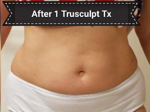 Before and After TruSculpt 3D After Before and After TruSculpt 3D After