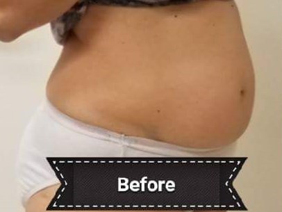 Before and After TruSculpt 3D Before Before and After TruSculpt 3D Before