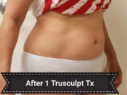 Before and After TruSculpt 3D After Before and After TruSculpt 3D After