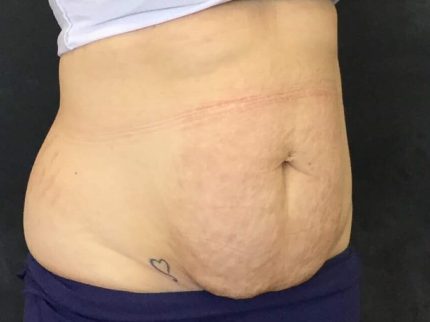 Before and After TightSculpt After Before and After TightSculpt After