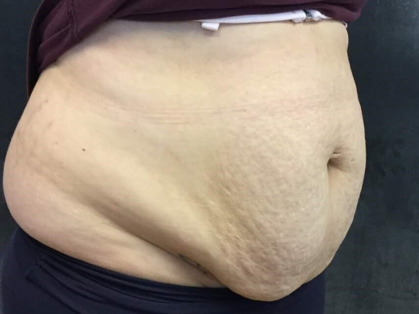 Before and After TightSculpt Before Before and After TightSculpt Before