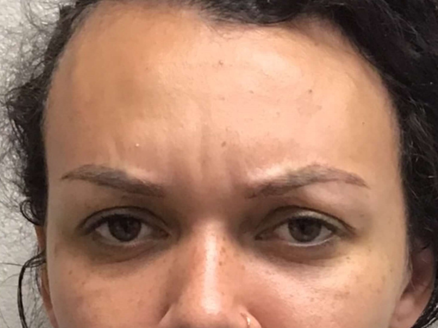 Before and After Botox After Before and After Botox After