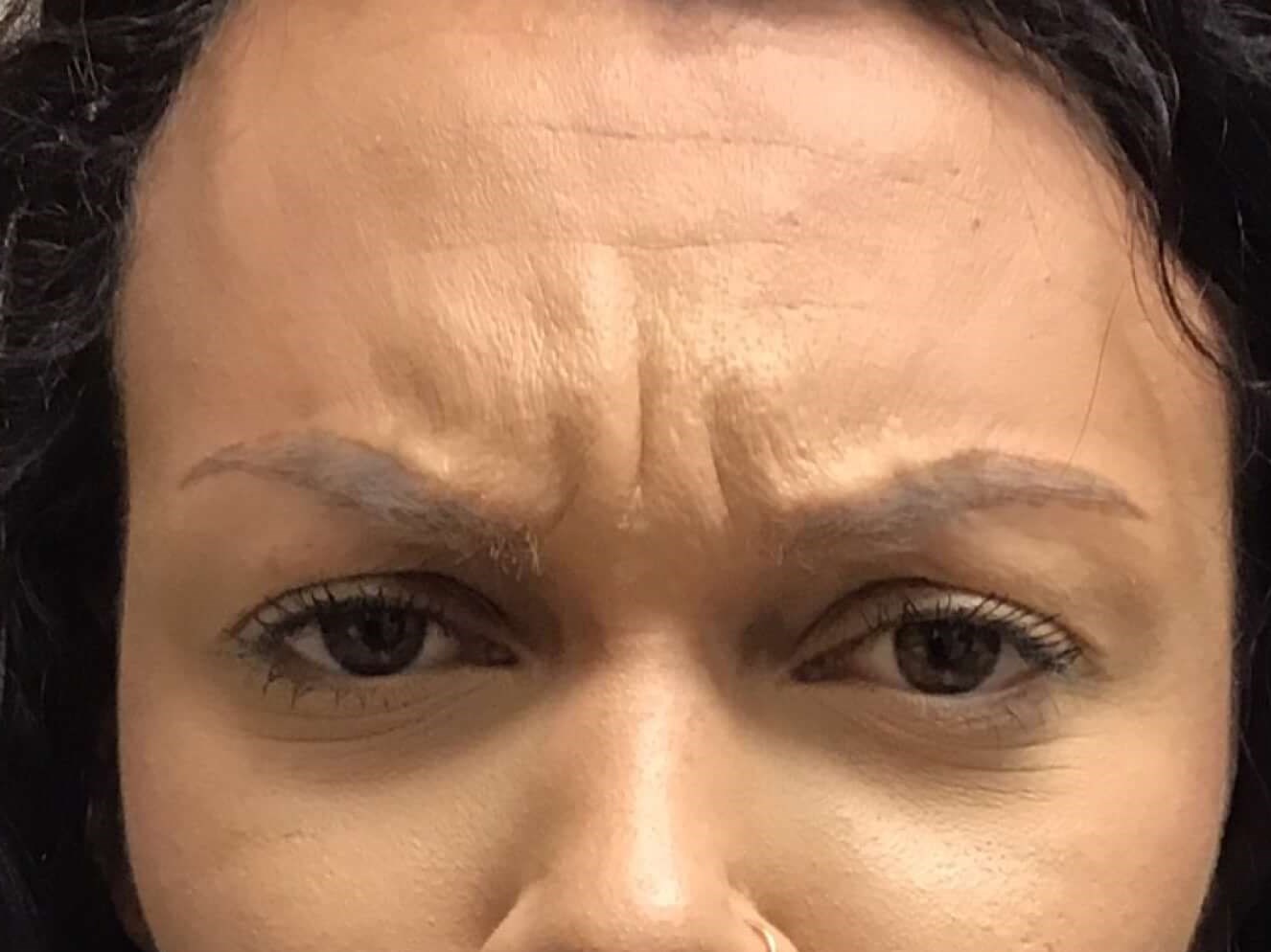 Before and After Botox Before Before and After Botox Before