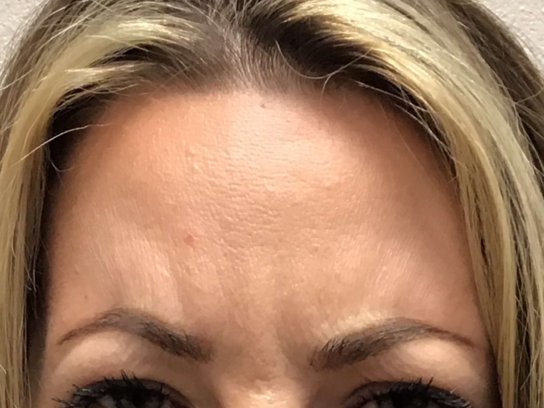 Before and After Botox After Before and After Botox After