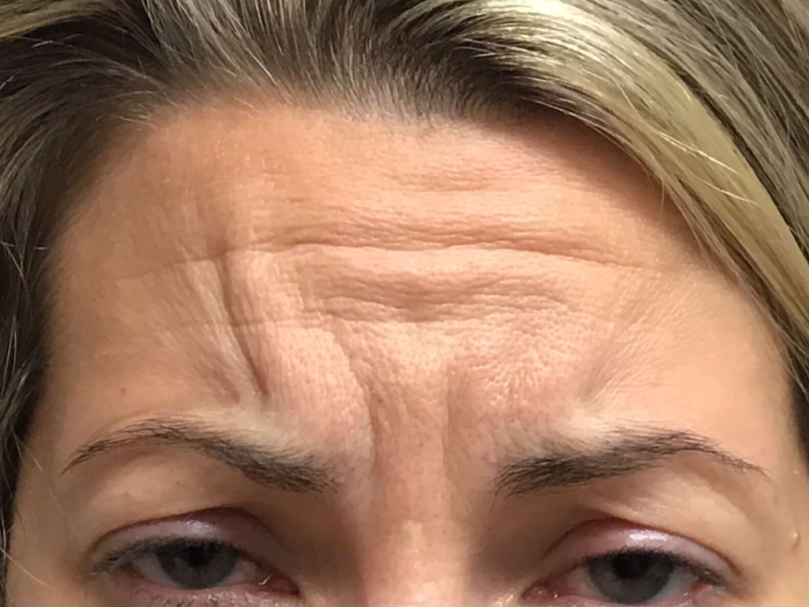 Before and After Botox Before Before and After Botox Before