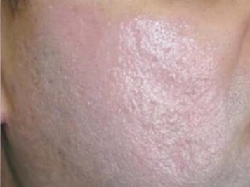 Laser Skin Resurfacing After Laser Skin Resurfacing After