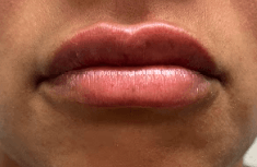 Before and After Lip Filler After