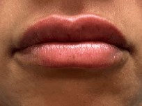 Before and After Lip Filler After
