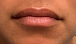 Before and After Lip Filler Before