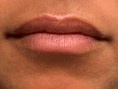 Before and After Lip Filler Before