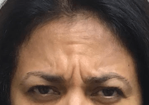 Glabellar Lines Solution Before