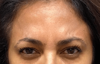 Glabellar Lines Solution After