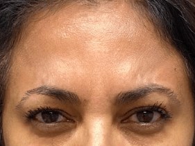 Glabellar Lines Solution After