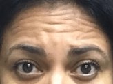 Forehead Wrinkles Solution Before