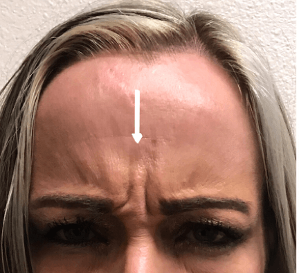 B&A Botox on Elevens Before