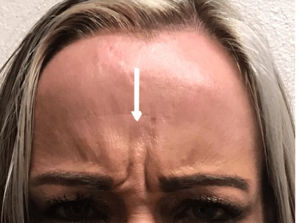 B&A Botox on Elevens Before