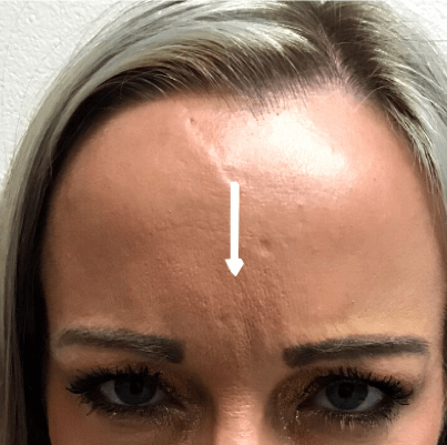 B&A Botox on Elevens After