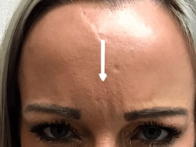 B&A Botox on Elevens After