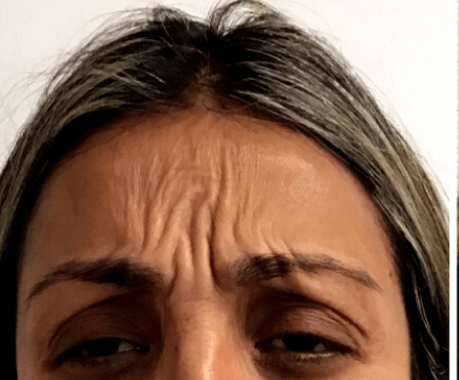 Forehead Wrinkles B&A Botox Before