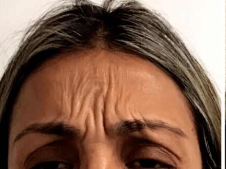 Forehead Wrinkles B&A Botox Before