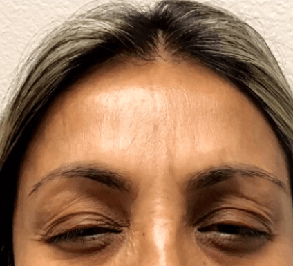 Forehead Wrinkles B&A Botox After