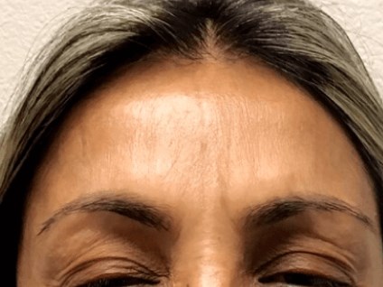 Forehead Wrinkles B&A Botox After
