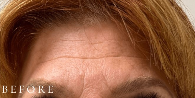 Dermal filler- Forehead Lines Before