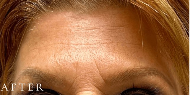 Dermal filler- Forehead Lines After
