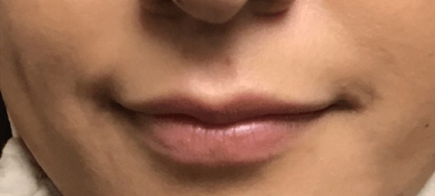 B&A Lip Filler Before