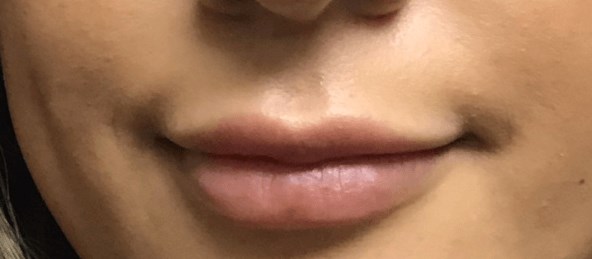 B&A Lip Filler After