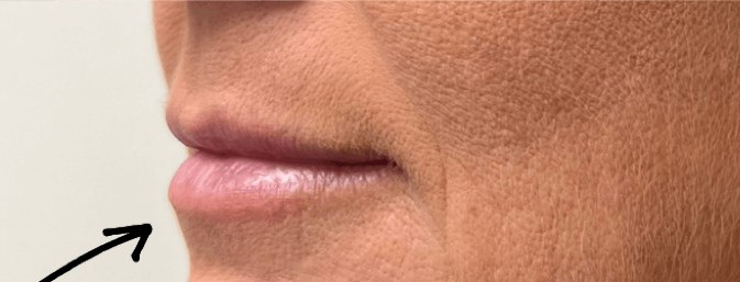 B&A Lip Filler Before