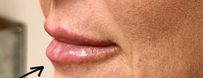 B&A Lip Filler After
