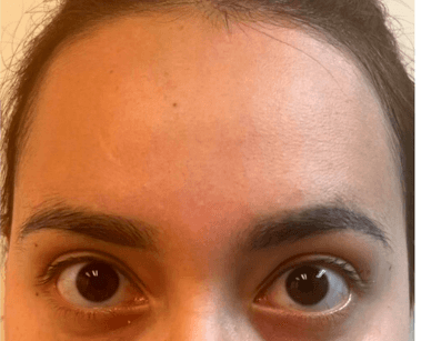 Xeomin for Forehead Wrinkles After
