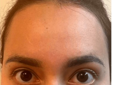 Xeomin for Forehead Wrinkles After