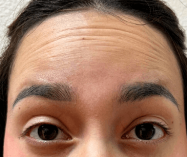 Xeomin for Forehead Wrinkles Before