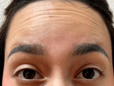 Xeomin for Forehead Wrinkles Before