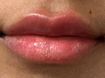 B&A Lip Filler (Front View) After