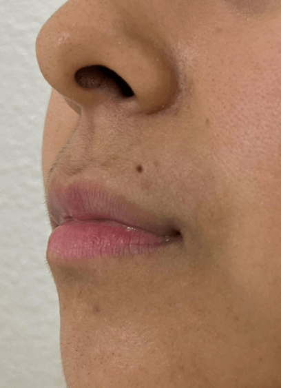 B&A Lip Filler (Side View) Before