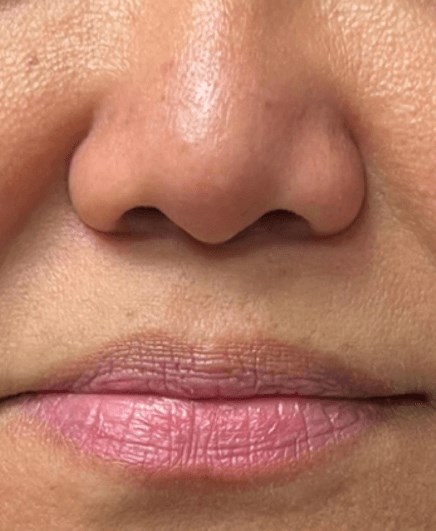 B&A Lip Filler Before